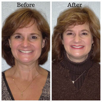 Happy Invisalign Patient before/after results