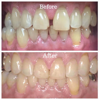 Results from Invisalign in Chesapeake